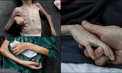 İsrail ablukası nedeniyle yetersiz beslenen Gazzeli çocukların üzerinde "ölüm" kol geziyor