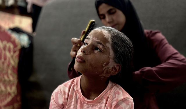 İsrail'in saldırıları nedeniyle saçlarına ak düşen Filistinli kız eski günlerine dönmek istiyor