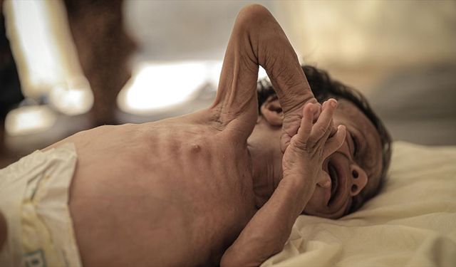 Sınır Tanımayan Doktorlar: Gazze’de akut yetersiz beslenen 5 yaş altı çocuk sayısı 3 kat arttı