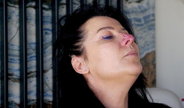 Arkadaşının köpeği tarafından burnu parçalanan kadının hukuk mücadelesi sürüyor